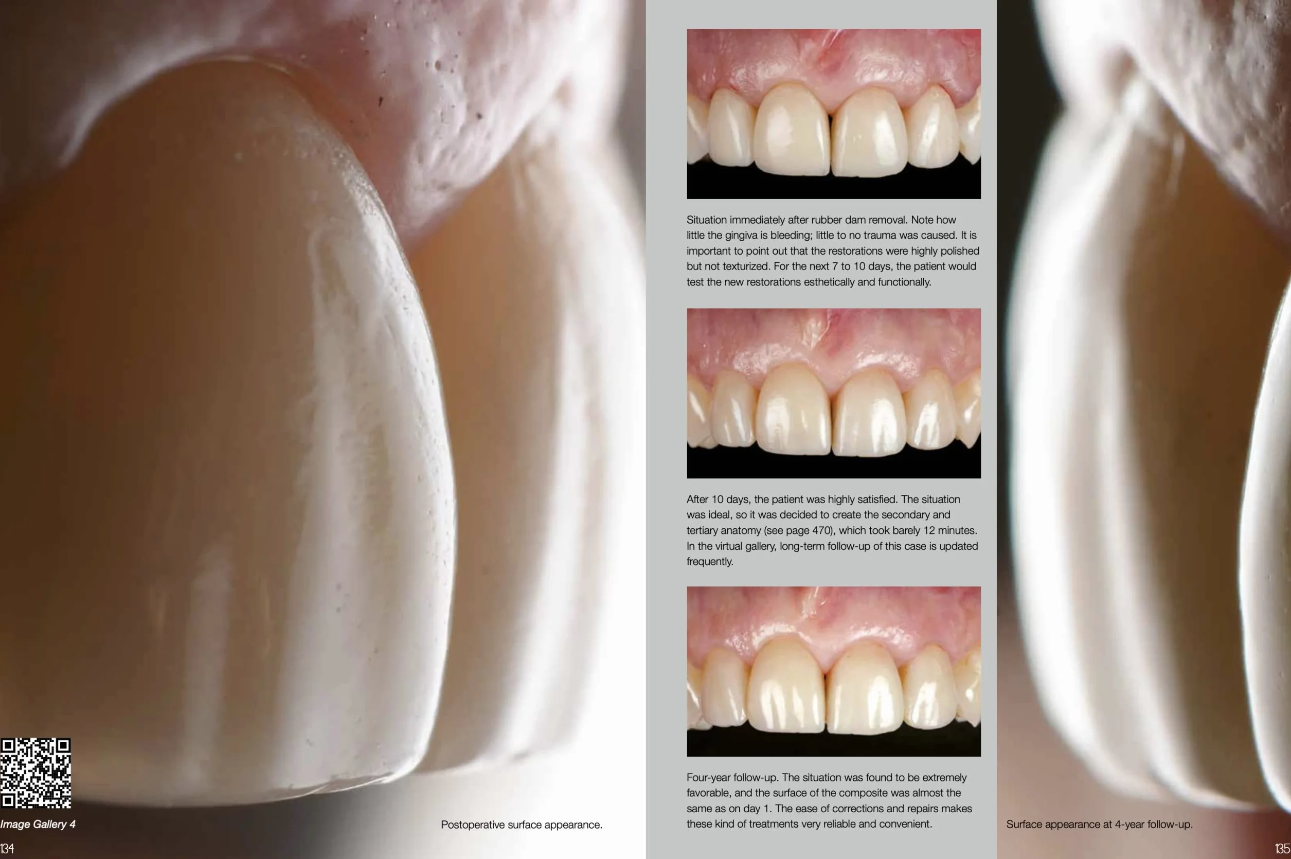 Layers 2. Direct composites: the Styleitaliano clinical secrets. Nuova ediz.