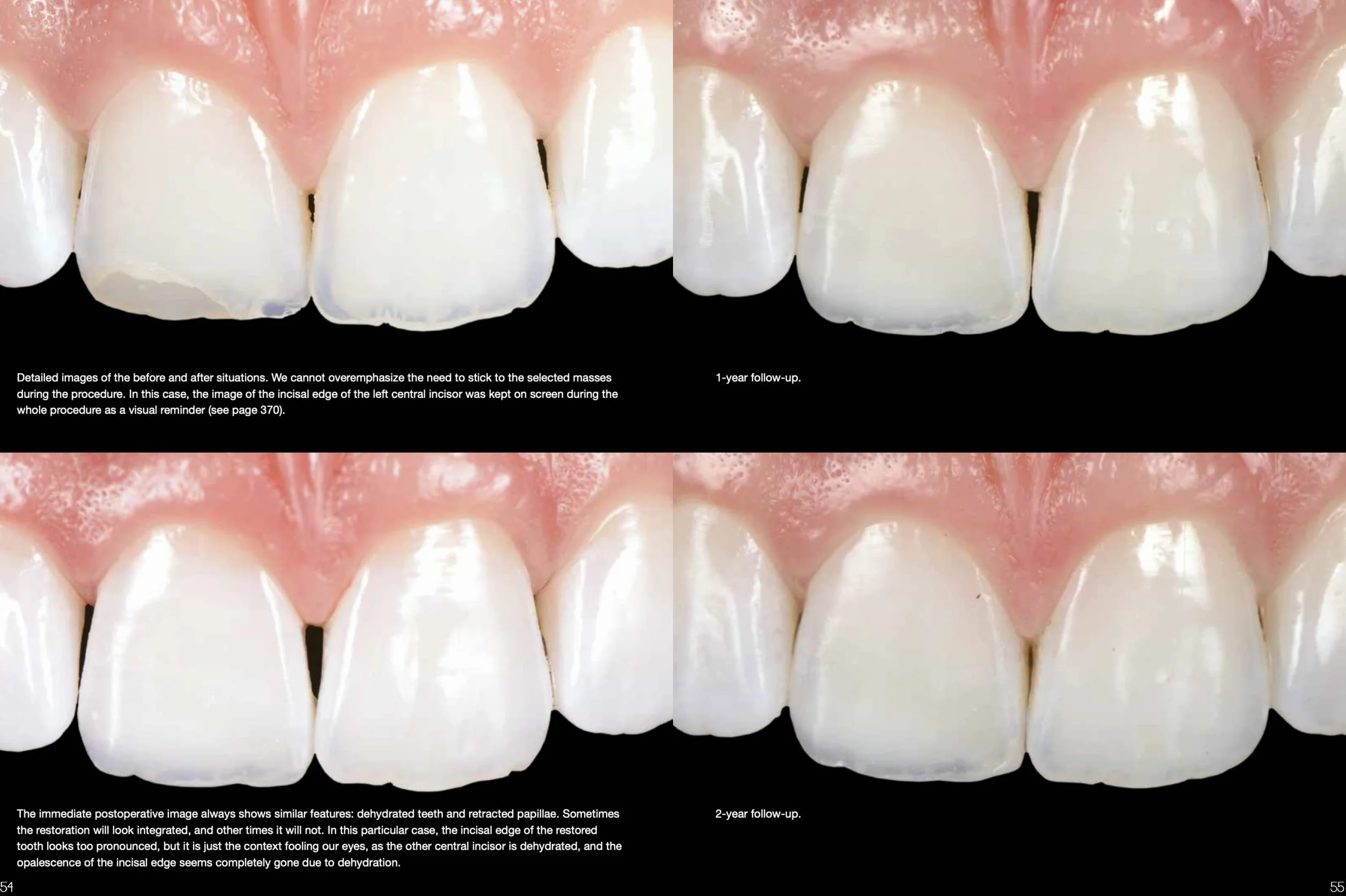 Layers 2. Direct composites: the Styleitaliano clinical secrets. Nuova ediz.