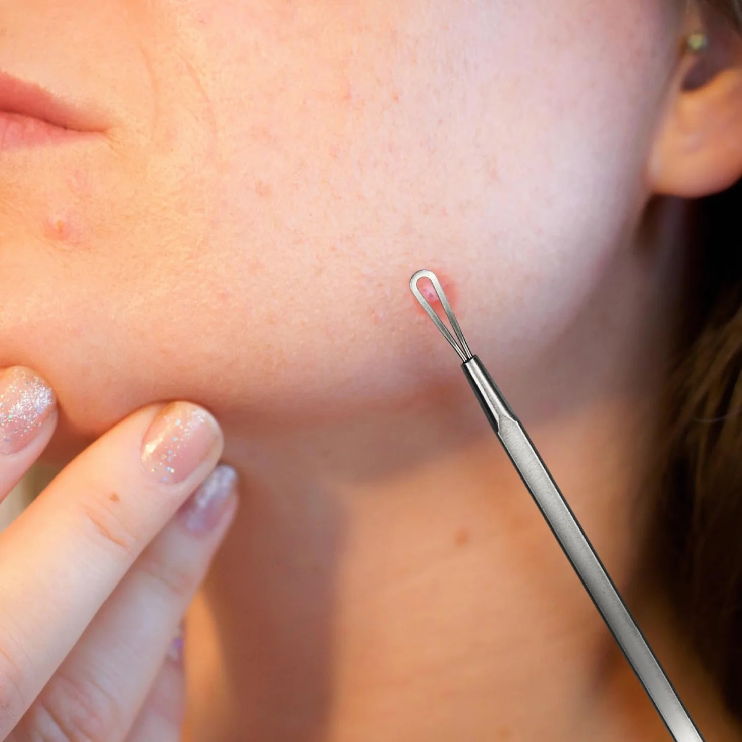 com-four® Zestaw do Usuwania Zaskórników – 5-czesciowe Narzedzia ze Stali Nierdzewnej do Oczyszczania Twarzy, Blackhead Remover – Ekstraktor Komedonów, Wyprysków i Zanieczyszczen dla Czystej Skóry