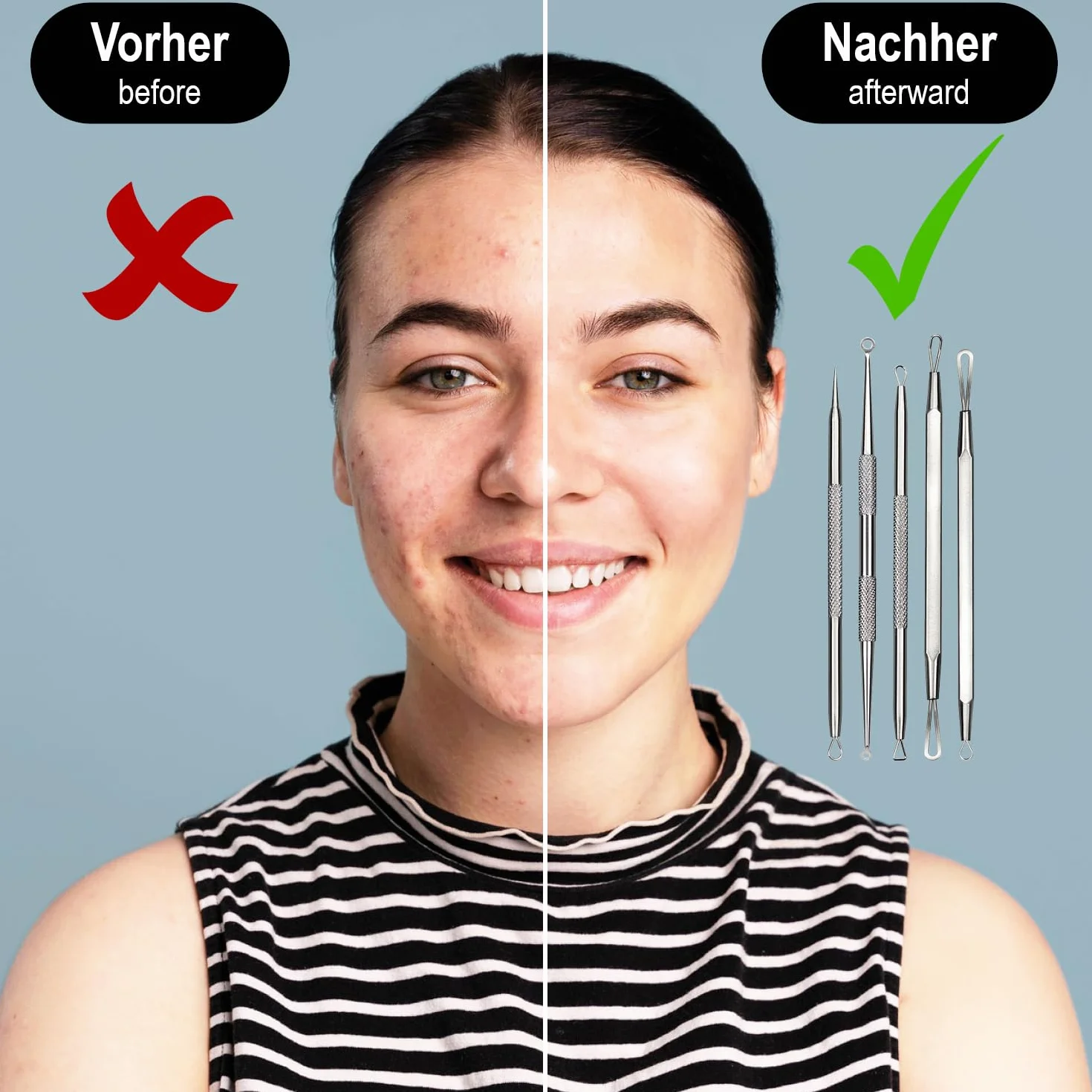com-four® Zestaw do Usuwania Zaskórników – 5-czesciowe Narzedzia ze Stali Nierdzewnej do Oczyszczania Twarzy, Blackhead Remover – Ekstraktor Komedonów, Wyprysków i Zanieczyszczen dla Czystej Skóry