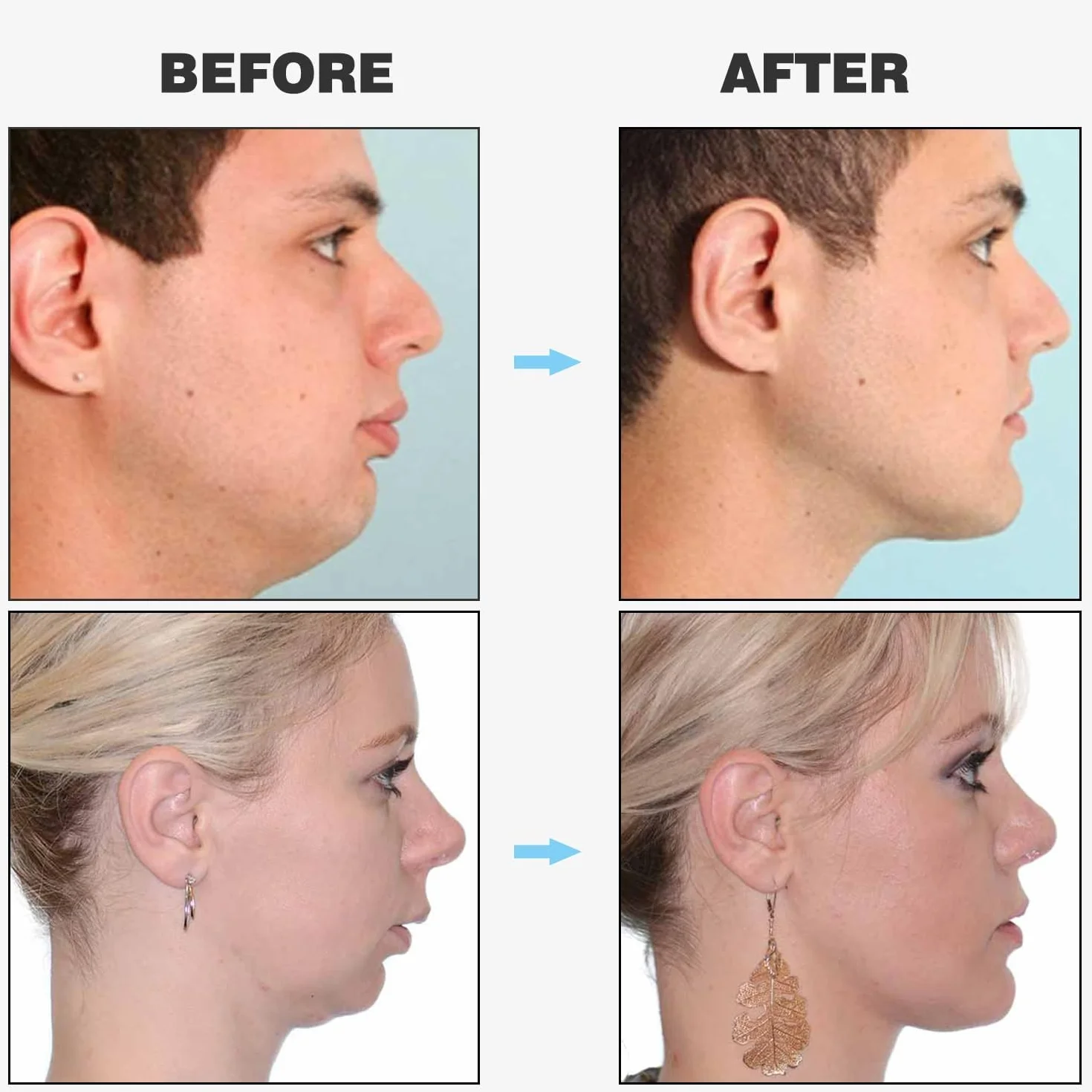 LATRAT Jawline Trainer 6 szt. - Ćwiczenie szczęki i twarzy