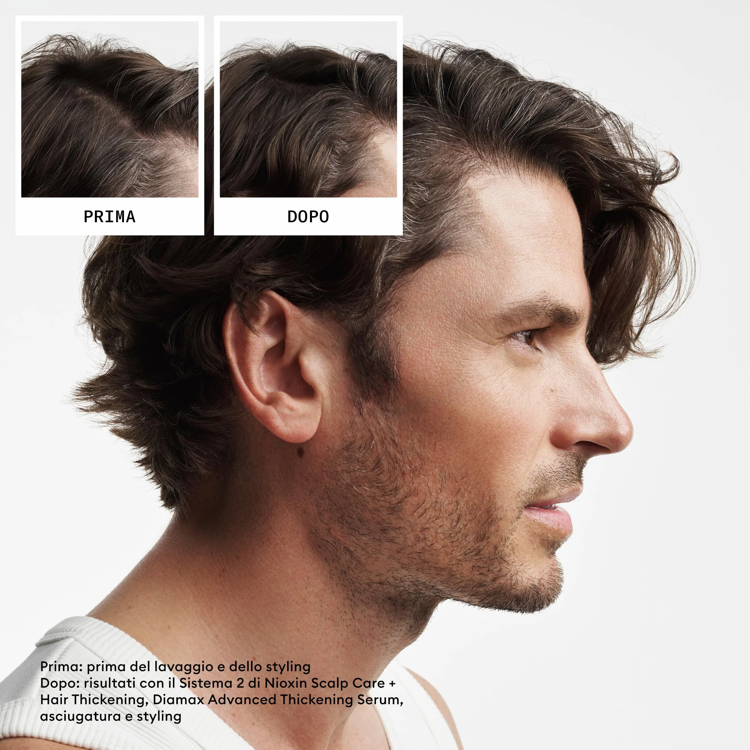 Nioxin Scalp + system zagęszczania włosów, 2 zestawy do trifazy, naturalne włosy z zaawansowanym przerzedzaniem - szampon, odżywka i pielęgnacja skóry głowy (300 + 300 + 100 ml)