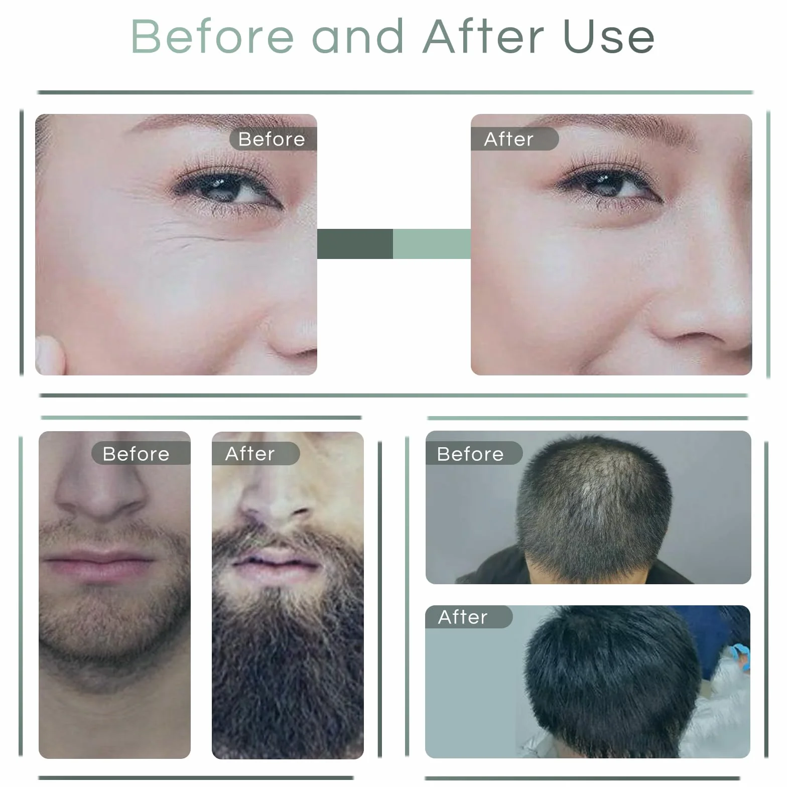 Profesjonalny Dermastamp 0-3 mm, 140 szpilek, do stymulowania wzrostu włosów, brody, twarzy