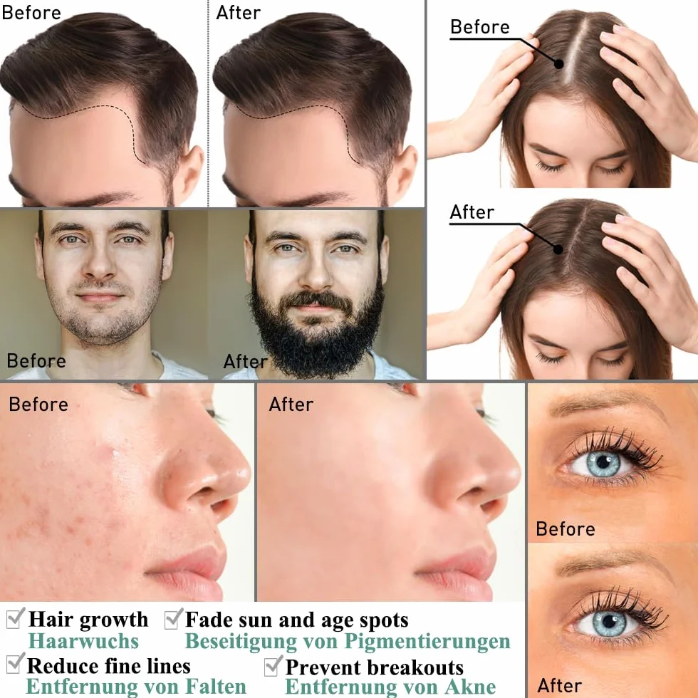 Derma Roller 1 mm 1,5 mm, wałek do mikroigłowania, wałek do brody, z 540 igłami, mikroigły, derma roller dla mężczyzn i kobiet, pielęgnacja włosów, twarzy i ciała, rozstępy, czarne