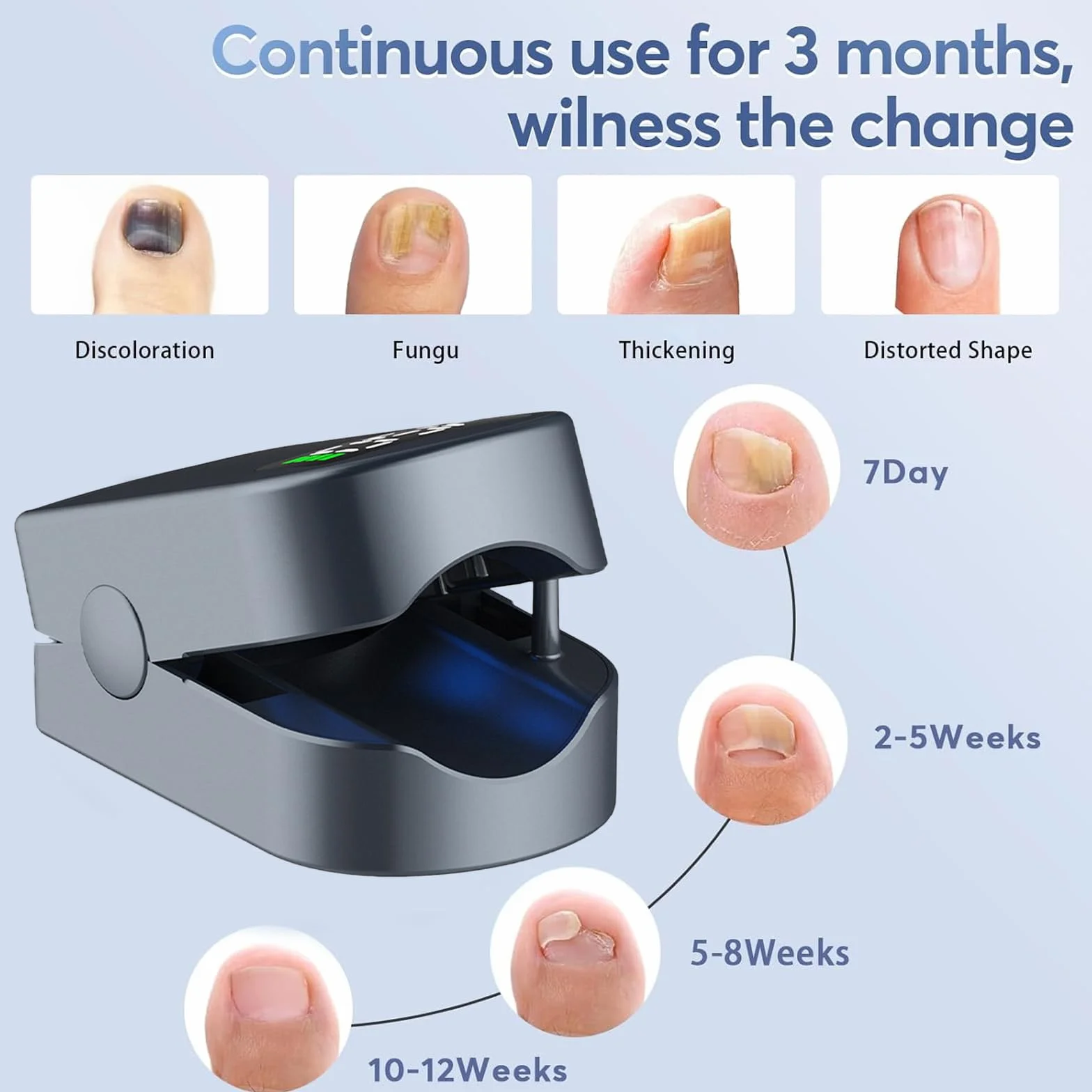 Upgrade Nail Fungus Laser Device with Time Display (D)