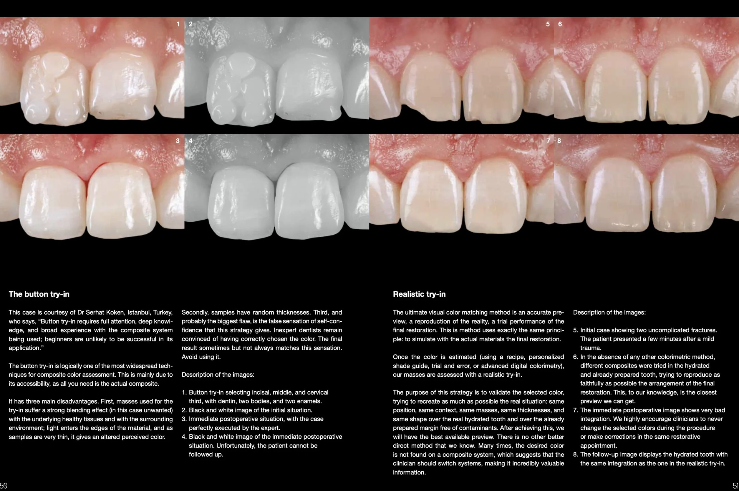 Layers 2. Direct composites: the Styleitaliano clinical secrets. Nuova ediz.