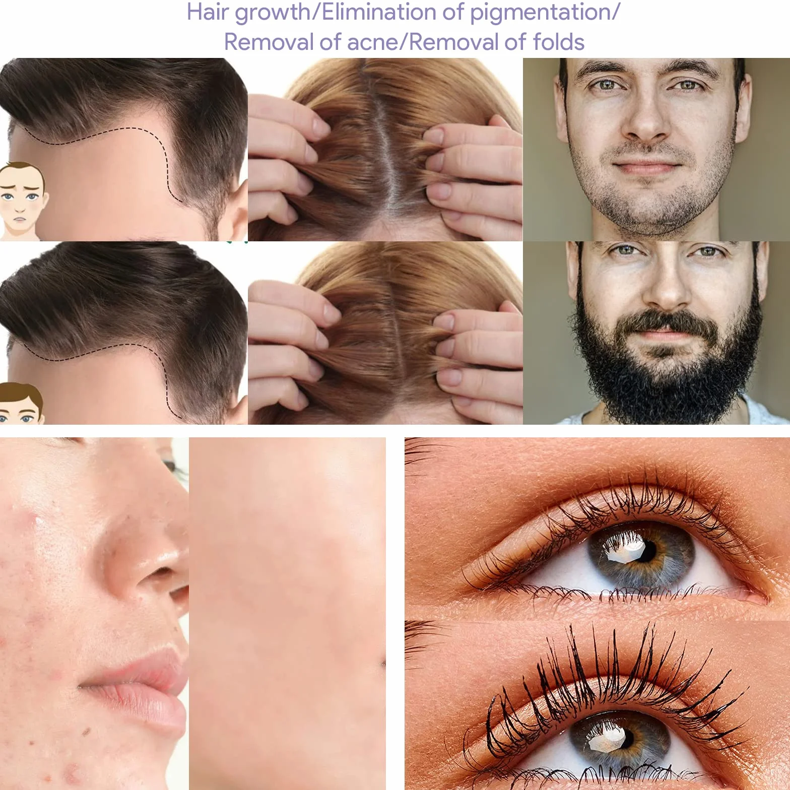 Derma Roller 1mm Tytanowe Mikroigły 0.5mm Mikroigły Uroda Twarzy Rolka